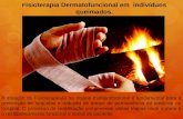 Fisioterapia dermatofuncional em queimados