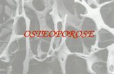 OSTEOPOROSE. O QUE É? Osteoporose, que significa osso poroso, é uma doença resultante da perda gradual da substância óssea que ocorre naturalmente com.