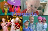 Progeria provém do Grego e significa envelhecimento prematuro. Progeria ou síndrome de Hutchinson- Gilford, é uma mutação génica extremamente rara, caracterizada.