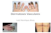 Dermatoses Vasculares Luiz Henrique Alves. Dermatoses Vasculares Síndrome dos dedos azuis Livedo reticular Acrocianose Eritromelalgia Raynaud Eritema.