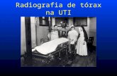 Radiografia de tórax na UTI. RX no Leito (AP)  O feixe de raios entra pela região ventral do paciente e o filme está colocado nas suas costas  Embora.