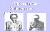 Hipertensão Pulmonar na DPOC Hipertensão Pulmonar na DPOC.