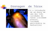 Drenagem de Tórax é a introdução de um dreno em uma das três cavidades do tórax (cavidade pleural, cavidade pericárdica ou mediastino)