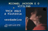 Michael Jackson E O Vitiligo