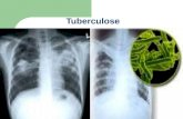 Trab Pronto D Tuberculose