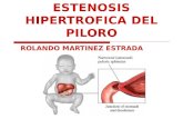 Estenosis Hipertrofica Del Piloro