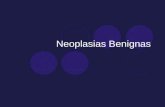 Neoplasias Benignas
