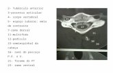 SISTEMA NERVOSO 2- Tubérculo anterior 3-processo articular 4- corpo vertebral 5- espaço subarac: meio de contraste 7-ramo dorsal 11-multifido 12-pedículo.