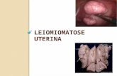 LEIOMIOMATOSE UTERINA. DEFINIÇÃO Leiomioma é o termo genérico que designa neoplasias benignas da musculatura lisa Pode ocorrer em todos os órgãos, inclusive.