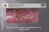 Mesma úlcera – após uma aplicação de TL (3 dias após) UNIVERSIDADE FEDERAL DE SANTA CATARINA DEPTO DE MICROBIOLOGIA E PARASITOLOGIA LABORATÓRIO DE ENTOMOLOGIA.