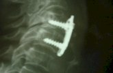 Espondilolistese Deslocamento sagital de uma vértebra sobre a outra subjacente. Classificação: displásico, ístmico, degenerativo,traumático, e patológico.