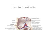 Hernia inguinalis.pptx