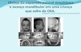 Efeitos da expansao palatal simultanea e avanço mandibularem uma criança que sofre de osa