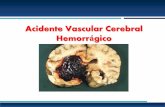 Acidente Vascular Cerebral Hemorrágico · Acidentes vasculares cerebrais: que tipo? 1. Acidentes isquémicos (75%?) AIT AVC plenamente constituídos 2. Hemorragias cerebrais (20%?)