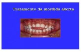 Tratamento da mordida aberta - moroortodontia.com.brmoroortodontia.com.br/aulaspg/mordida aberta.pdf · n Altura dentoalveolar aumentada Alterações na mandíbula ... mordida profunda.