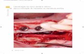 Lateralização do nervo dentário inferior para a colocação ...dentalface.net/images/artigos/Lateral.pdf · bem como a posição e trajeto do nervo alveolar inferior, o caso deve