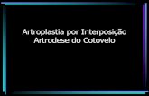 Artroplastia por Interposição Artrodese do Cotoveloortobook.com.br/wp-content/uploads/.../9/1353495466-ARTCOTOVELO.pdf · Articulação Cotovelo •Complexa: –radio-capitelar