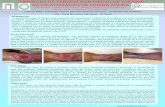 O IMPACTO DA TERAPIA POR ONDAS DE CHOQUE NA …cmta.com.br/wp-content/uploads/2016/03/MARI_3.Poster-RADLA-ferida... · A terapia por ondas de choque extra-corpórea (TOC) revolucionou