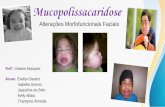 Mucopolissacaridose - Home - Fonovim · Alterações em lábios, língua, bochechas, mandíbula, palato duro e arcada dentária são frequentes em pacientes com MPS, comprometendo