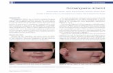 Hemangioma infantil - files.bvs.brfiles.bvs.br/upload/S/1413-9979/2013/v18n4/a3844.pdf · Diagn Tratamento. 2013;18(4):141-4. Dermatologia Hemangioma infantil Vanessa Mello Tonolli