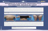 bvsms.saude.gov.brbvsms.saude.gov.br/bvs/publicacoes/poster_ac_dermatite_flagelada.pdf · No entanto, uma hiperpigmentação linear da pele que ocorre durante o uso da bleomicina,