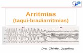 Arritmias - Cibic Laboratorios · Taquiarritmias Taquicardia ventricular Monomorfa Cardiopatia estructural (cardiopatia isquemica cronica, MCD) Sin cardiopatia estructural Polimorfa