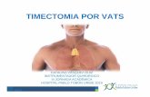 6 TIMECTOMIA POR VATS · -localizaciÒn y separaciÒn roma del timo de las innominadas-secciÒn de los paquetes vasculares tÌmicos entre clips o con energia avanzada-visualizaciÒn