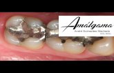 Unidade 7 - Amálgama - André Machado Apresentação Comercial Limalha (diferentes metais como pó) + mercúrio (líquido) Pastilhas (comprimidos) Cápsulas pré dosadas (amalgamação