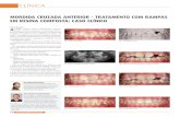 MORDIDA CRUZADA ANTERIOR - TRATAMENTO COM RAMPAS … .pdf · 2017-07-14 · esmalte, mobilidade e fratura dos dentes anteriores, patologia periodontal e dist r - bios da ATM 5. Caso