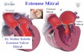 Normal. Estenose Mitral Valva Mitral · Dispnéia (perda da complacência pulmonar e preenchimento intersticial e alveolar p/líquido). 2. Edema Agudo nos Pulmões 3. Tosse, Hemoptise,