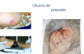 Úlcera de pressão...Úlcera de pressão: definida como qualquer lesão causada por pressão não aliviada que resulta em danos nos tecidos subjacentes (tecido subcutâneo, músculo,