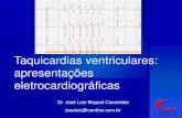 Taquicardias ventriculares: apresentações eletrocardiográficas · Quando a TV tem origem na região basal do VE, o eixo de despolarização ventricular está dirigido inferiormente,