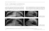 Caso radiológico pediátrico - CONICYT · tuberculosis de la pared torácica2. Las hernias congénitas son causadas por de-bilidad de la fascia endotorácica. Se producen ya sea